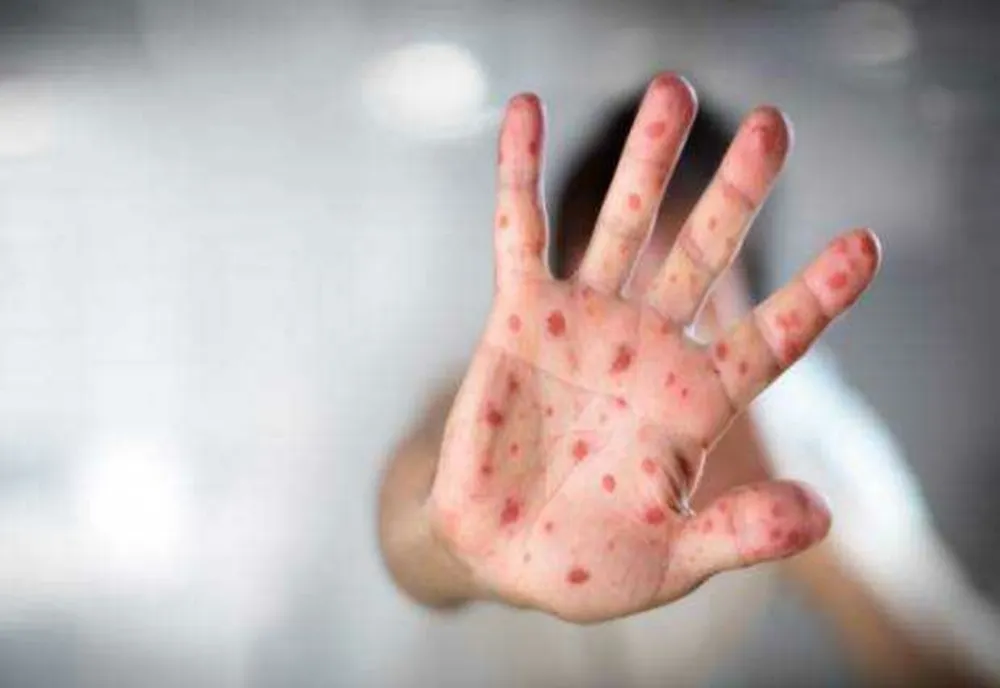 Risc uriaș de epidemie de rujeolă în România. Vaccinul ROR lipsește în mai multe județe