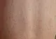Numărul cazurilor de SCARLATINĂ, în creștere alarmantă, în România